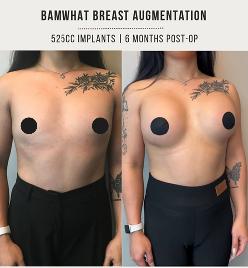 Breast implants 1