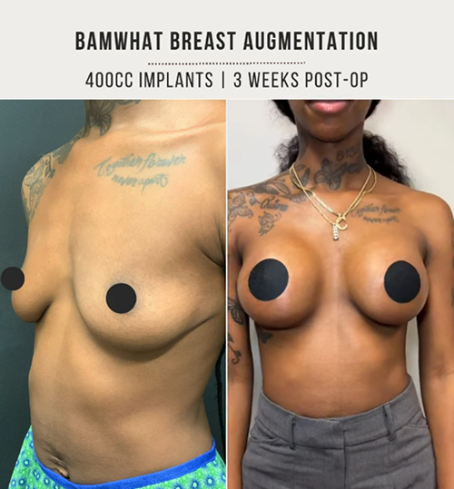 Breast implants 2