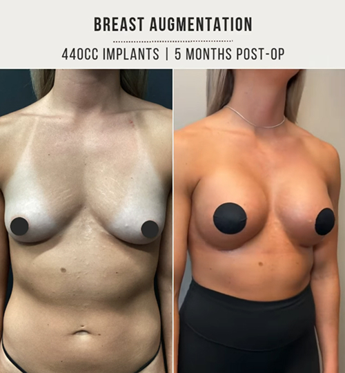 Breast implants 3