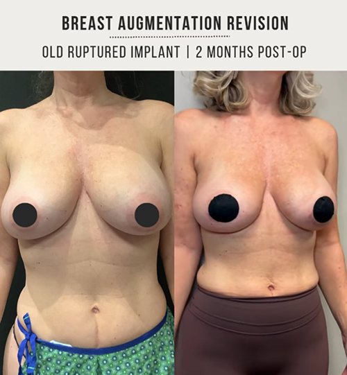 Breast implants 4