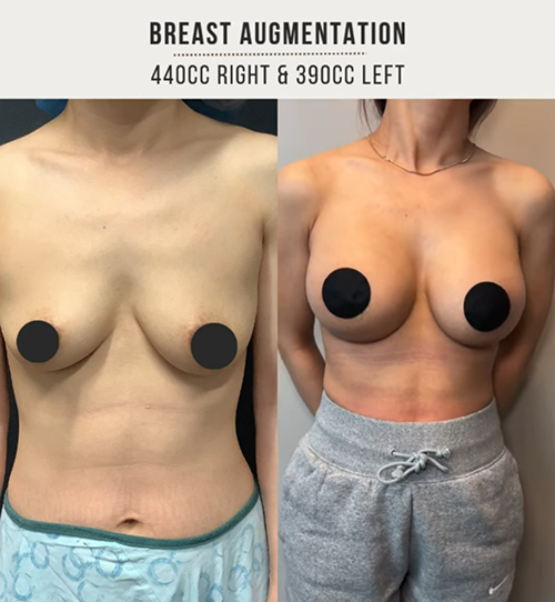Breast implants 5